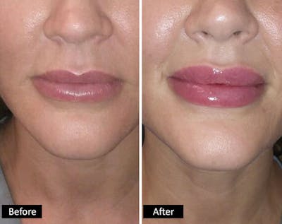 Lips & Chin Before & After Gallery - Patient 407077 - Image 1