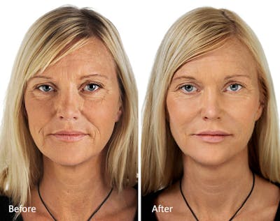 Cheeks & Nose Before & After Gallery - Patient 142472 - Image 1