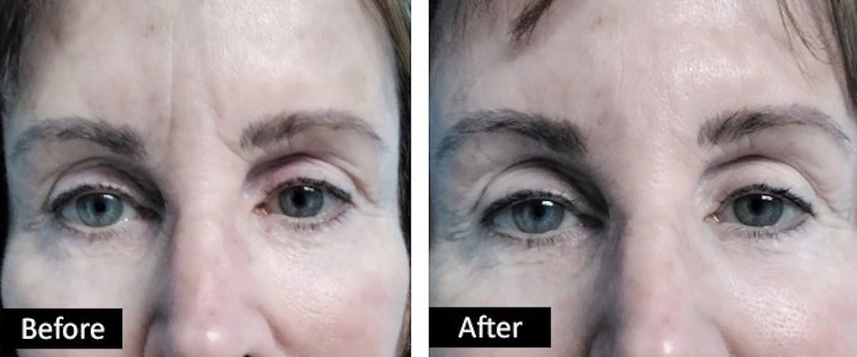 Eyes & Forehead Before & After Gallery - Patient 257073 - Image 1