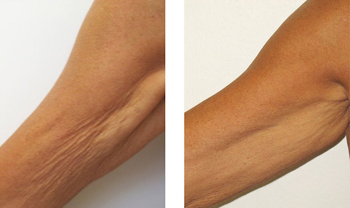 Sculptra for Crepey Skin Before & After Gallery - Patient 225198 - Image 1