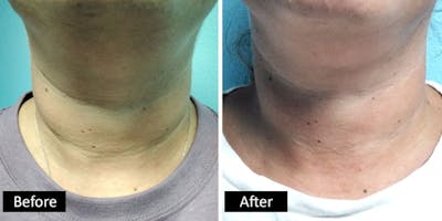 Neck Before & After Gallery - Patient 183763 - Image 1