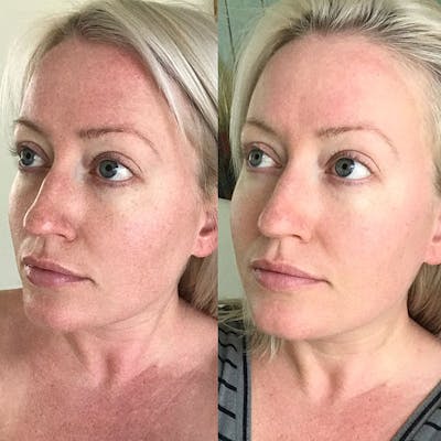 Diamond Glow Before & After Gallery - Patient 105132 - Image 1