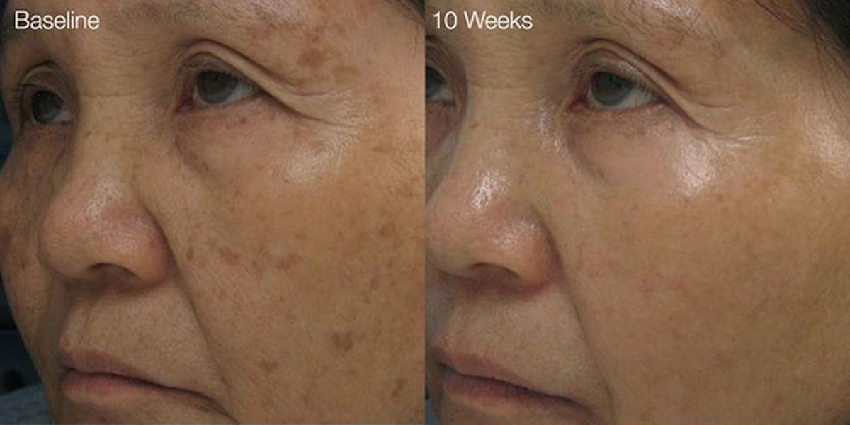 Diamond Glow Before & After Gallery - Patient 464016 - Image 1