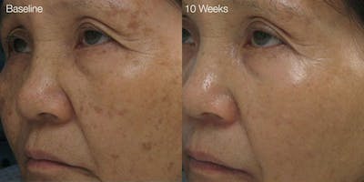 Diamond Glow Before & After Gallery - Patient 464016 - Image 1