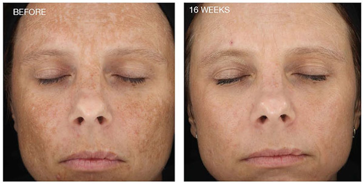 Diamond Glow Before & After Gallery - Patient 411362 - Image 1