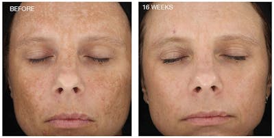 Diamond Glow Before & After Gallery - Patient 411362 - Image 1