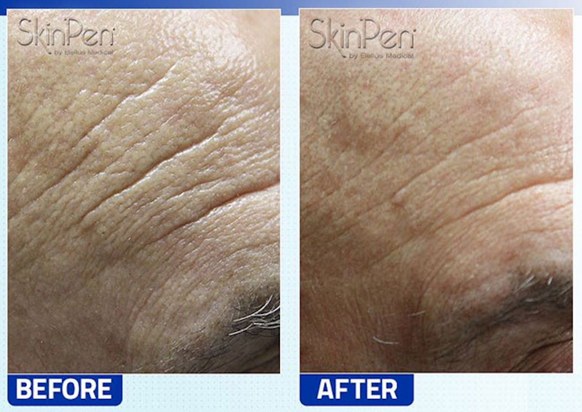 SkinPen Microneedling Before & After Gallery - Patient 383179 - Image 1