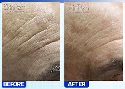 SkinPen Microneedling Before & After Gallery - Patient 383179 - Image 1