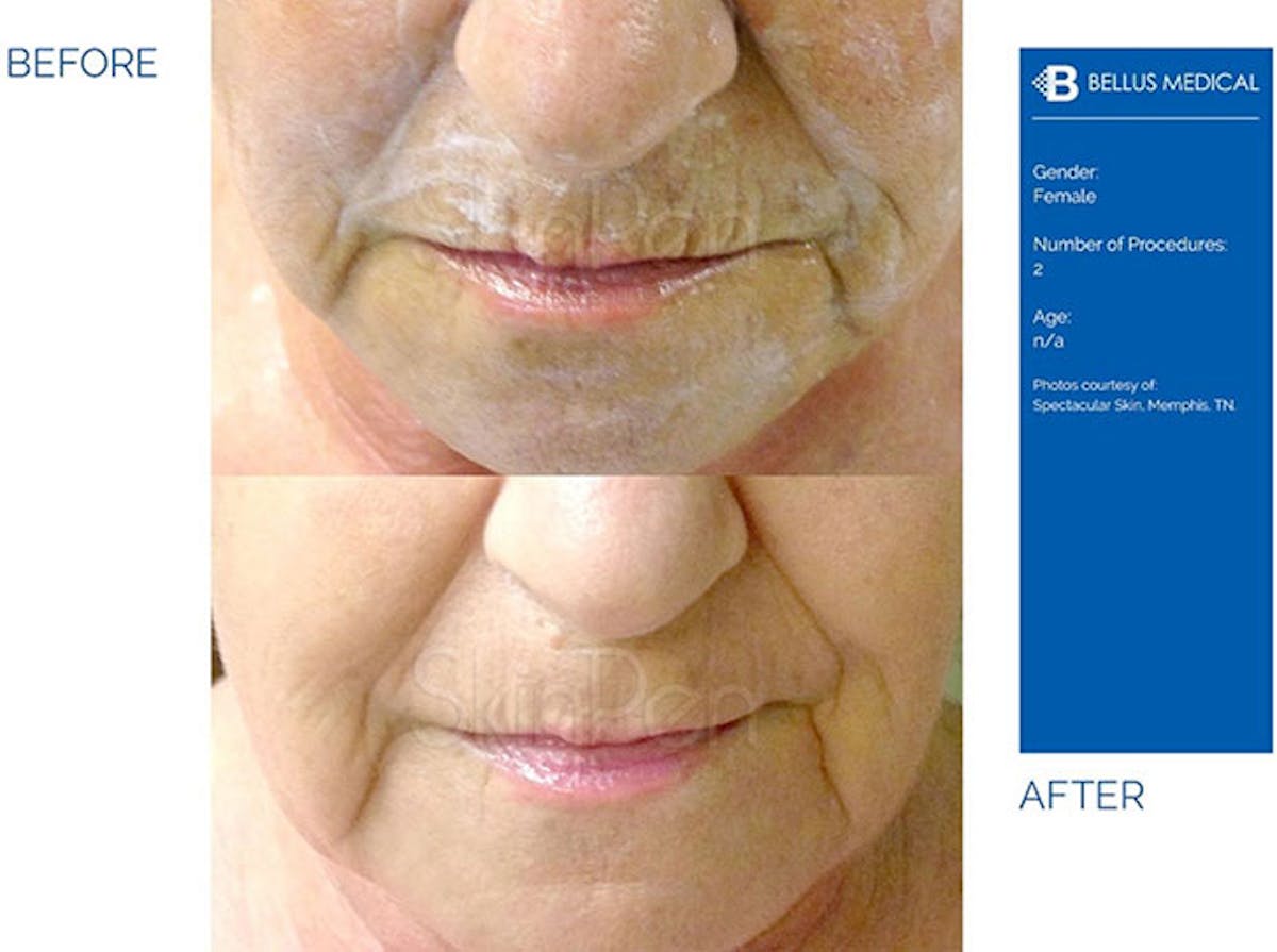 SkinPen Microneedling Before & After Gallery - Patient 319715 - Image 1
