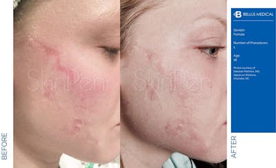 SkinPen Microneedling Before & After Gallery - Patient 201918 - Image 1