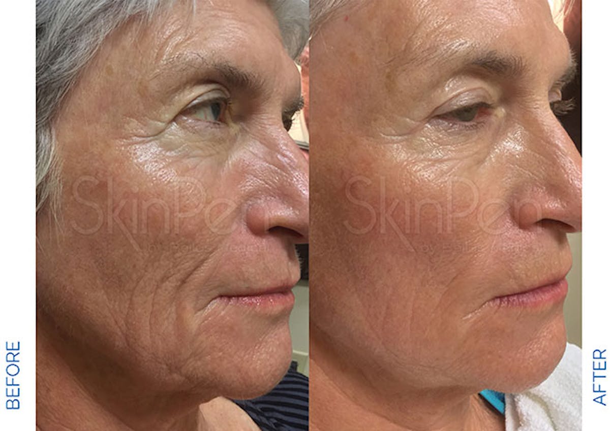 SkinPen Microneedling Before & After Gallery - Patient 174271 - Image 1