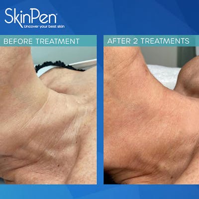 SkinPen Microneedling Before & After Gallery - Patient 134222 - Image 1