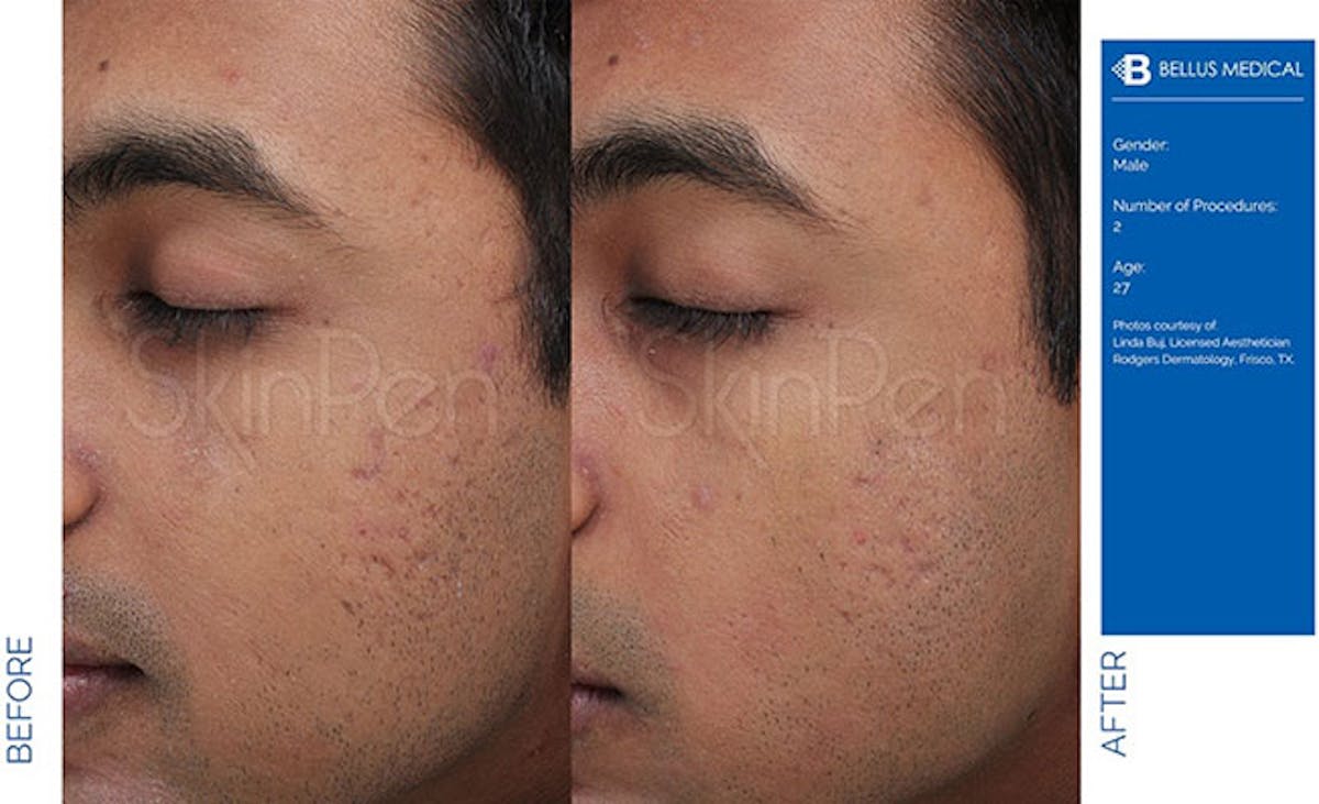SkinPen Microneedling Before & After Gallery - Patient 390162 - Image 1