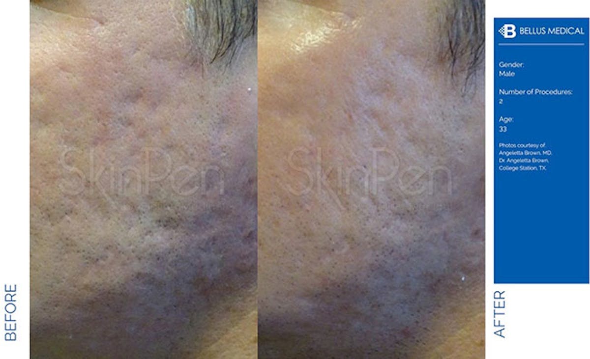 SkinPen Microneedling Before & After Gallery - Patient 307271 - Image 1
