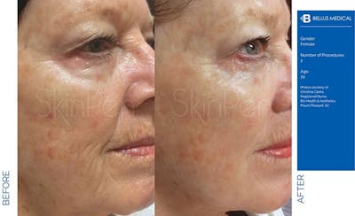 SkinPen Microneedling Before & After Gallery - Patient 313266 - Image 1
