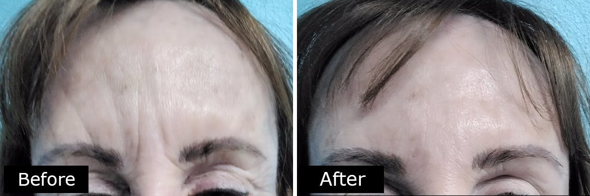 Dermal Fillers Before & After Gallery - Patient 189159 - Image 1