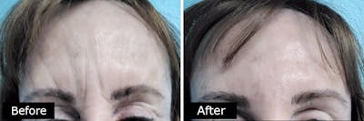 Dermal Fillers Before & After Gallery - Patient 189159 - Image 1