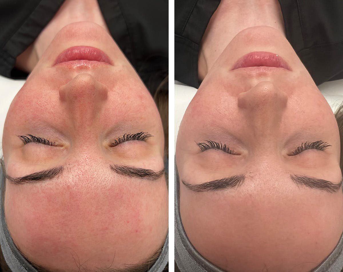 Diamond Glow Before & After Gallery - Patient 276896 - Image 1