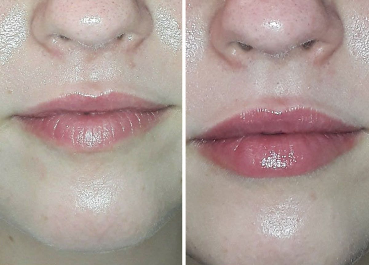 Kysse Before & After Gallery - Patient 172043 - Image 1