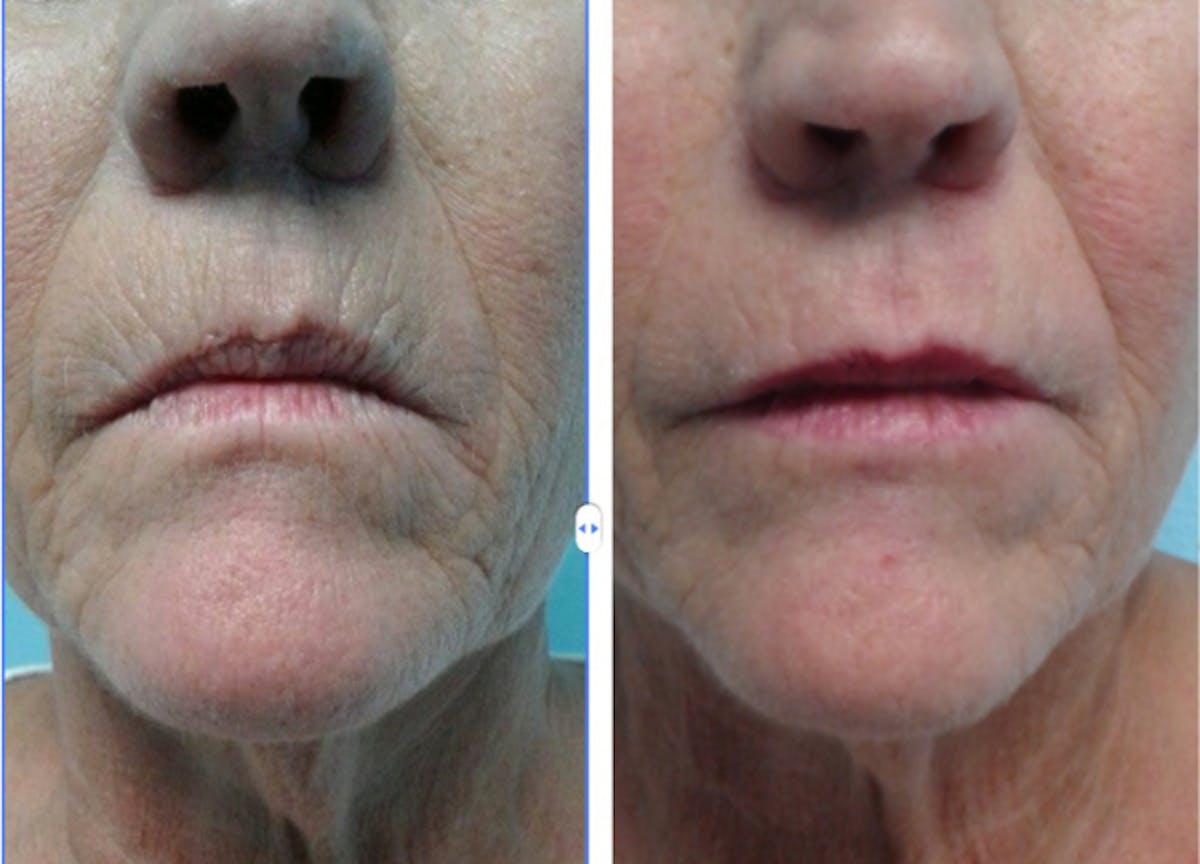 Kysse Before & After Gallery - Patient 139235 - Image 1