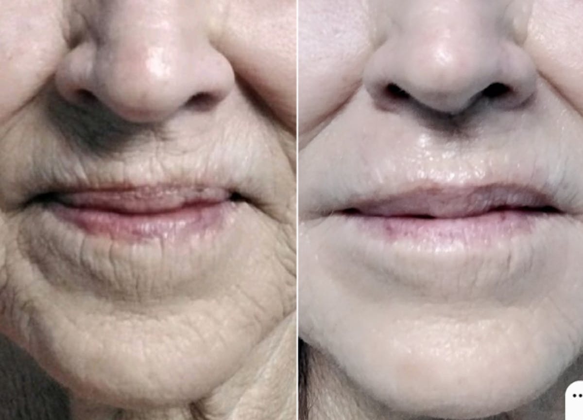 Kysse Before & After Gallery - Patient 268372 - Image 1