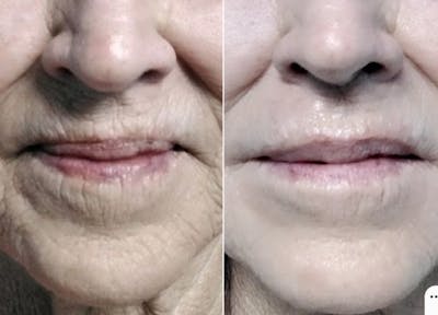 Kysse Before & After Gallery - Patient 268372 - Image 1