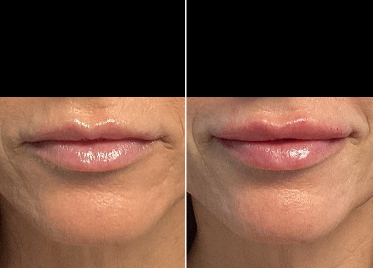 Kysse Before & After Gallery - Patient 286896 - Image 1
