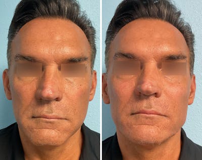 Fillers/Injectables Before & After Gallery - Patient 286945 - Image 1