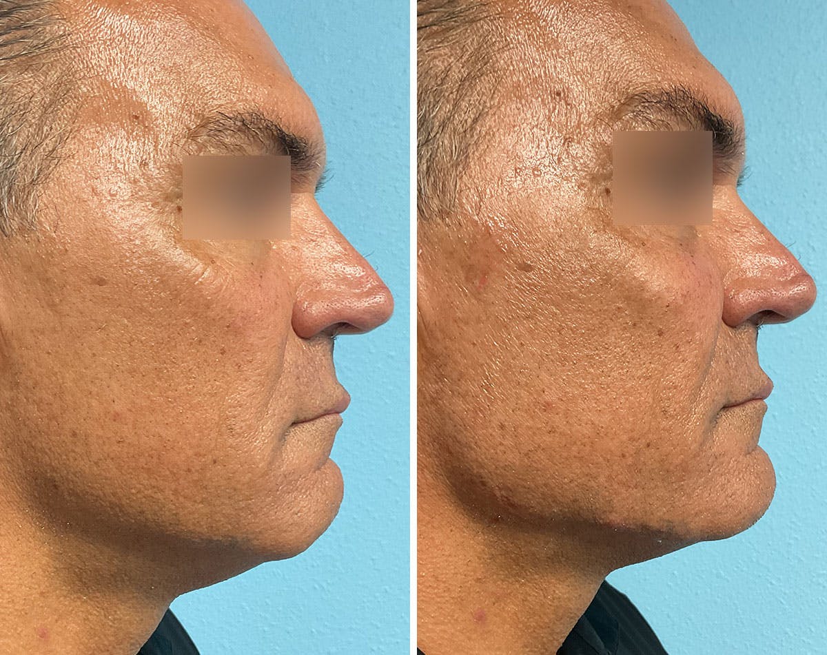Fillers/Injectables Before & After Gallery - Patient 286945 - Image 2
