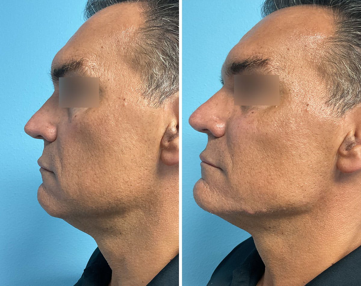 Fillers/Injectables Before & After Gallery - Patient 286945 - Image 3