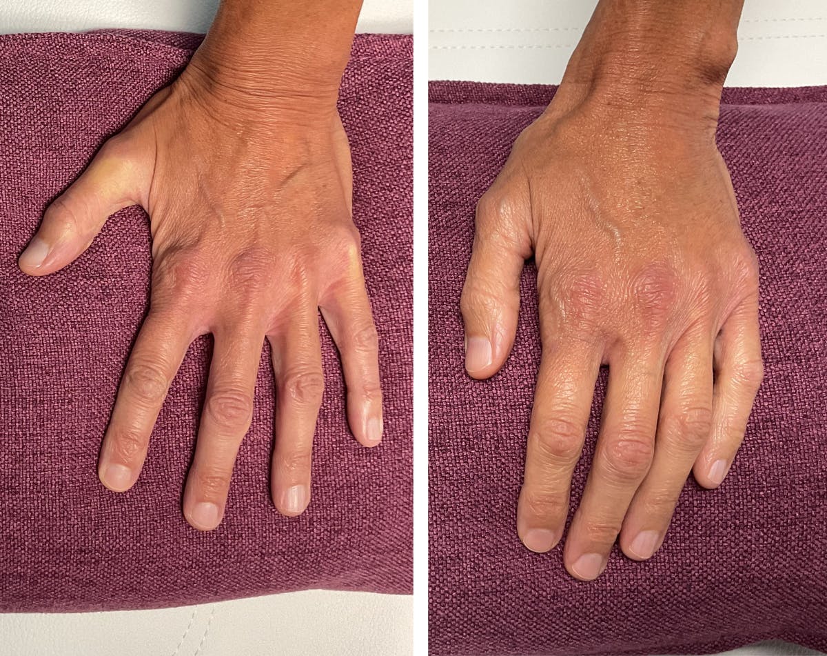 Dermal Fillers Before & After Gallery - Patient 257279 - Image 2