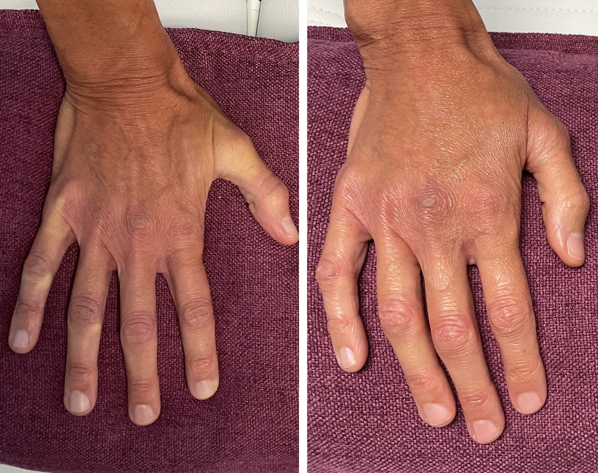 Dermal Fillers Before & After Gallery - Patient 257279 - Image 1