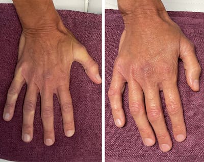 Dermal Fillers Before & After Gallery - Patient 257279 - Image 1