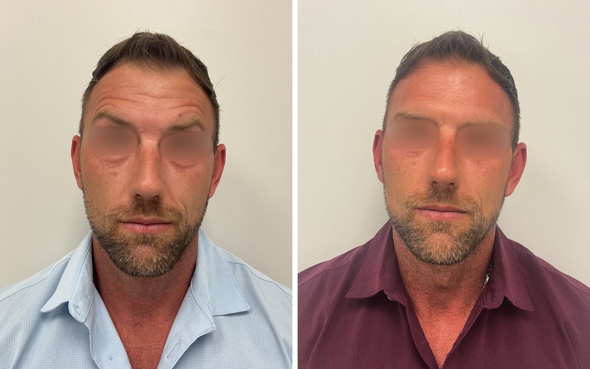 Fillers/Injectables Before & After Gallery - Patient 405556 - Image 1