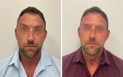 Fillers/Injectables Before & After Gallery - Patient 405556 - Image 1