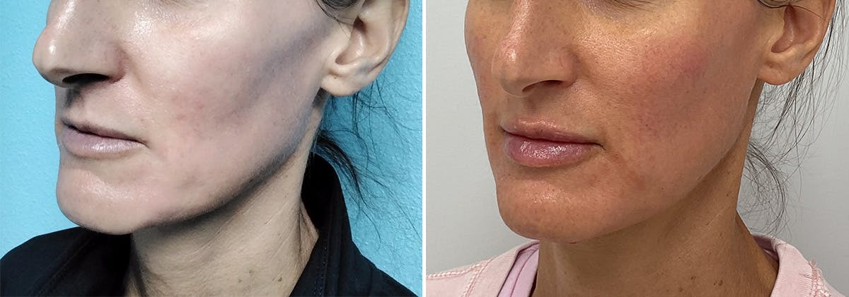Cheeks & Lips Before & After Gallery - Patient 255044 - Image 1