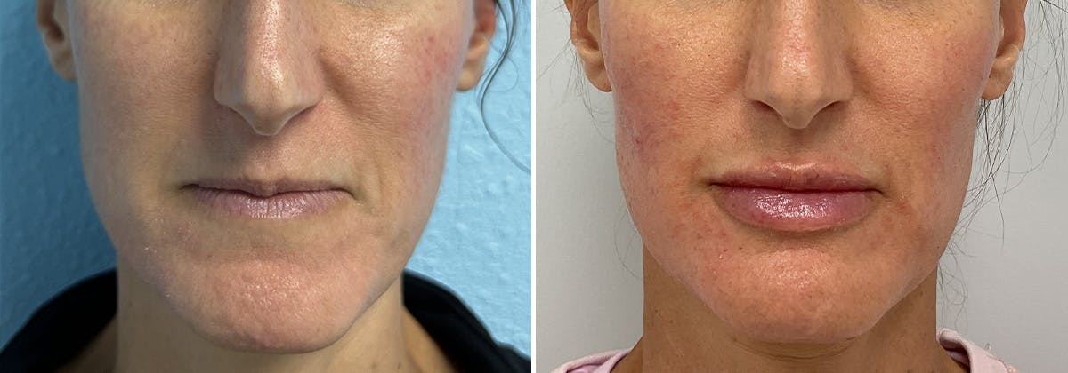 Cheeks & Lips Before & After Gallery - Patient 255044 - Image 2