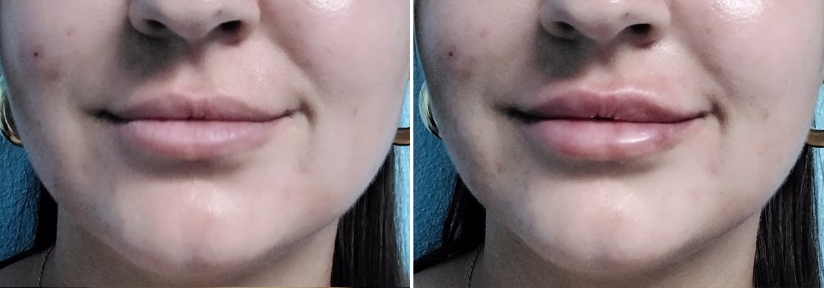 Juvederm Before & After Gallery - Patient 357123 - Image 1