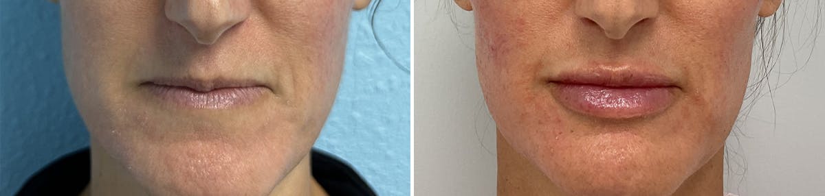Kysse Before & After Gallery - Patient 158687 - Image 1