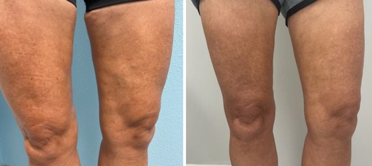 Radiesse Filler for Body Before & After Gallery - Patient 363245 - Image 2