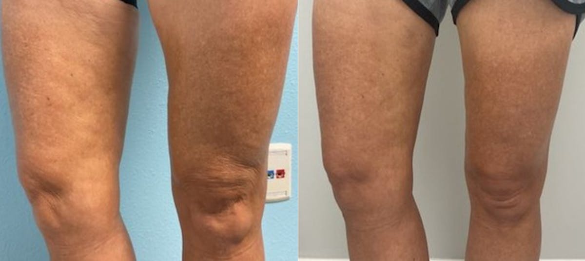 Radiesse Filler for Body Before & After Gallery - Patient 363245 - Image 1