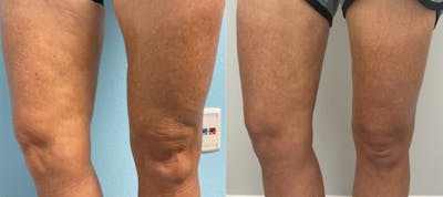 Radiesse Filler for Body Before & After Gallery - Patient 363245 - Image 1