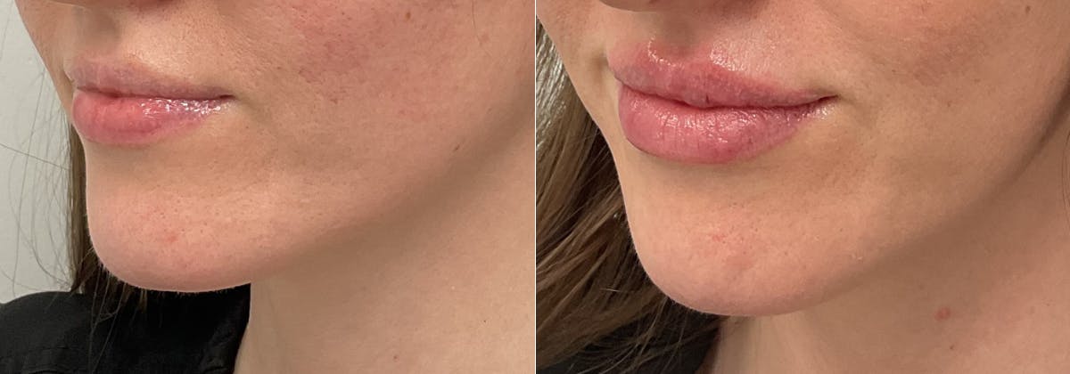 Juvederm Before & After Gallery - Patient 231701 - Image 2
