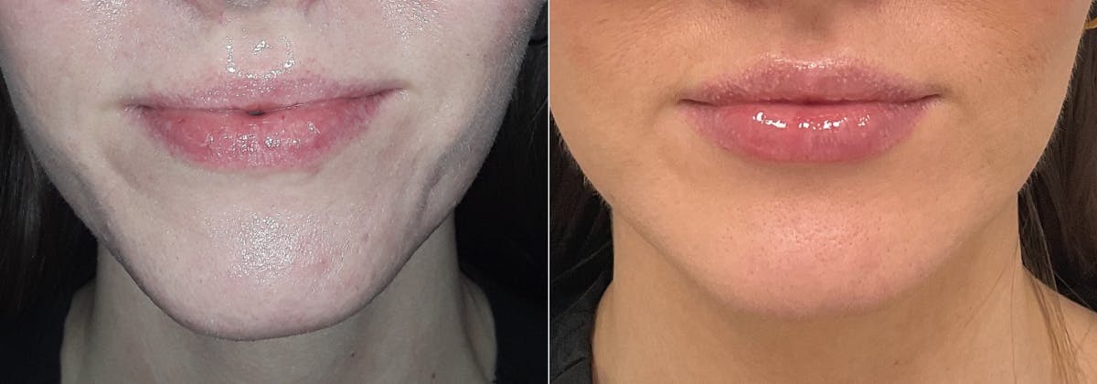 Juvederm Before & After Gallery - Patient 231701 - Image 1