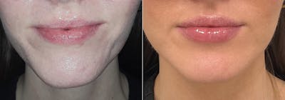 Juvederm Before & After Gallery - Patient 231701 - Image 1