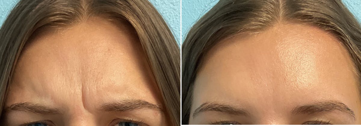 Dermal Fillers Before & After Gallery - Patient 166796 - Image 1