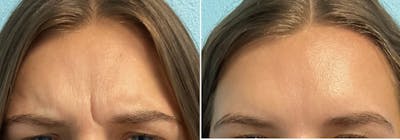 Xeomin Before & After Gallery - Patient 351699 - Image 1