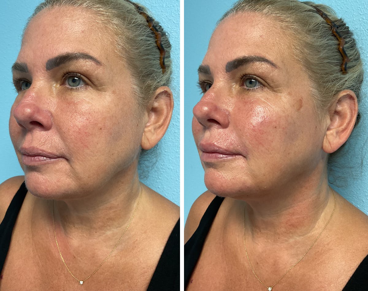 Evolysse Before & After Gallery - Patient 759374 - Image 1