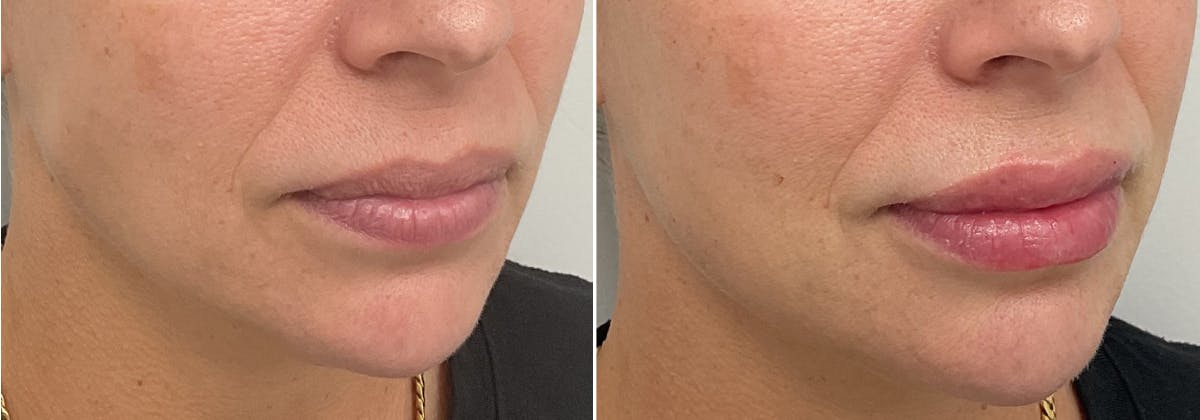 Juvederm Before & After Gallery - Patient 340504 - Image 1