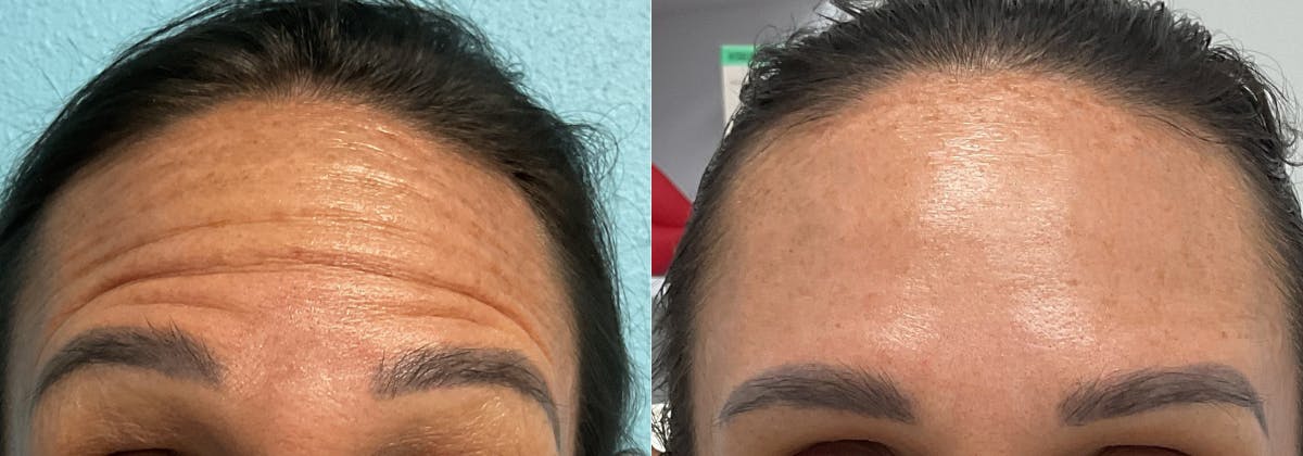 Xeomin Before & After Gallery - Patient 252736 - Image 1
